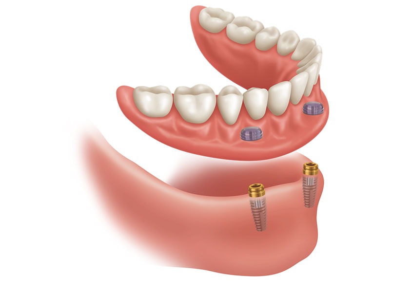 Dental Implants | Mirage Dental | General and Family Dentist | SE Calgary