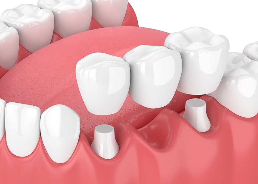 Dental Bridges Calgary | Family Dental Centre | General and Family Dentist | SE Calgary