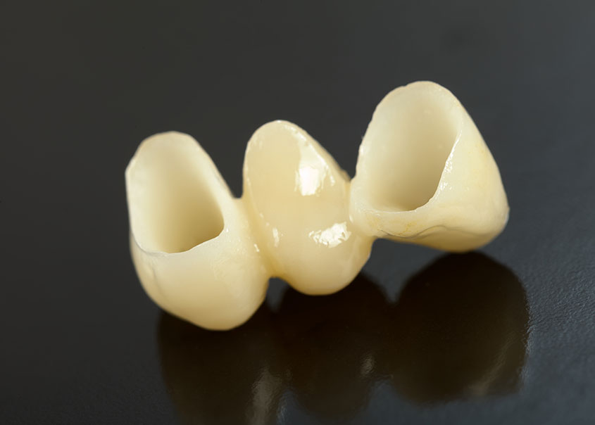 Dental Bridges Treatment | Mirage Dental | General and Family Dentist | SE Calgary