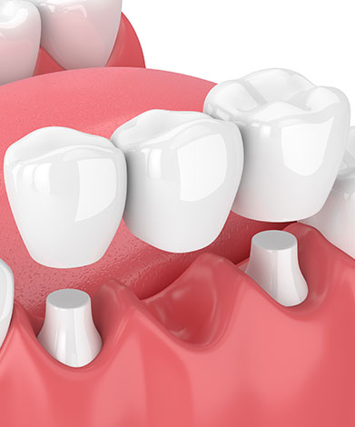 Dental Bridges | Mirage Dental | General and Family Dentist | SE Calgary