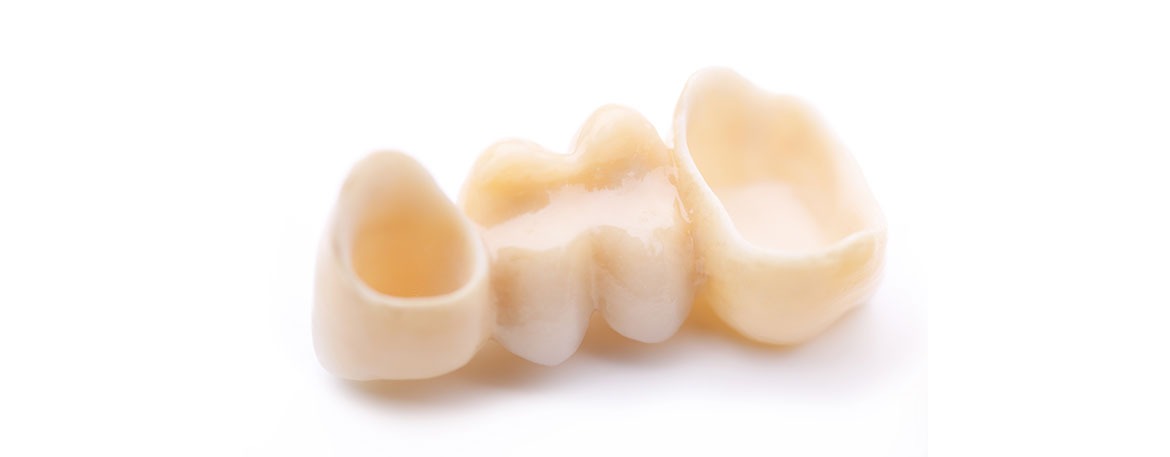 SE Calgary Dental Bridges | Mirage Dental | General and Family Dentist | SE Calgary