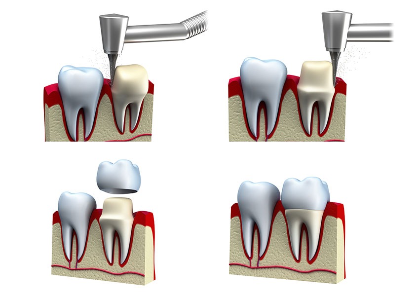 Dental Crowns | Mirage Dental | General and Family Dentist | SE Calgary