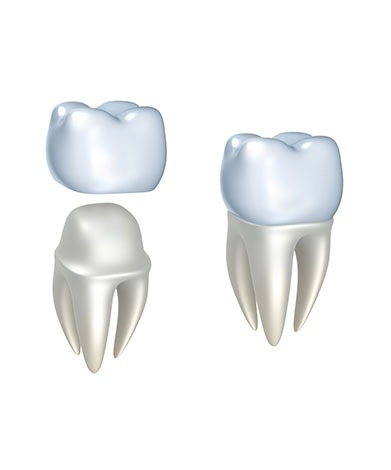 Dental Crowns | Mirage Dental | General and Family Dentist | SE Calgary
