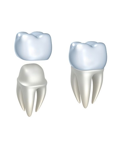 Calgary Dental Crowns | Mirage Dental | General and Family Dentist | SE Calgary