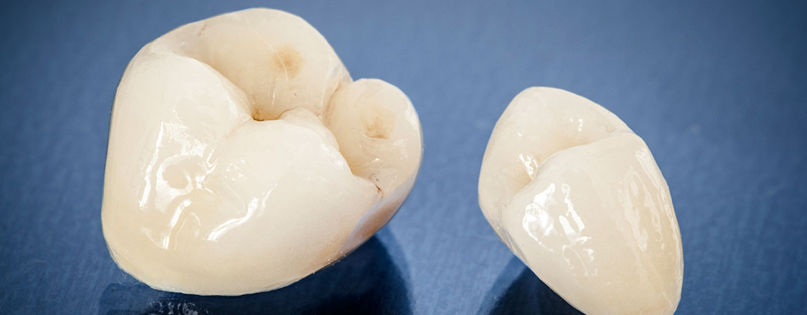 Dental Crowns Treatment | Mirage Dental | General and Family Dentist | SE Calgary