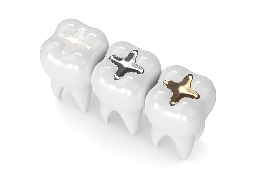 Dental Fillings | Mirage Dental | General and Family Dentist | SE Calgary