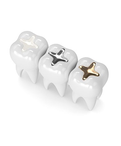 Dental Fillings | Mirage Dental | General and Family Dentist | SE Calgary