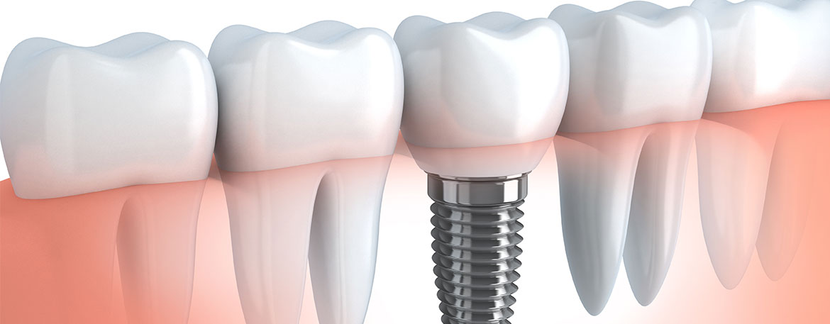 Dental Implants | Mirage Dental | General and Family Dentist | SE Calgary