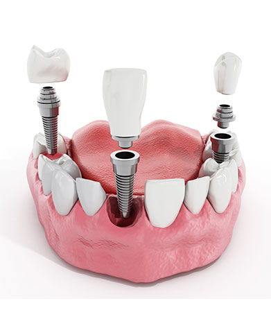 Dental Implants | Mirage Dental | General and Family Dentist | SE Calgary