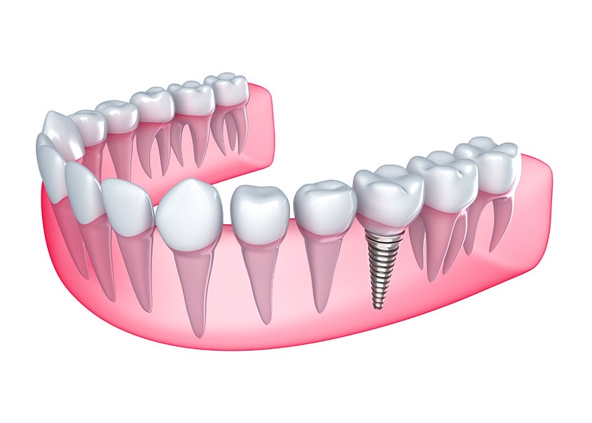 Dental Implants | Mirage Dental | General and Family Dentist | SE Calgary