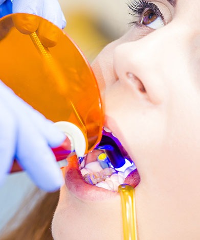 Dental Sealants | Mirage Dental | General and Family Dentist | SE Calgary