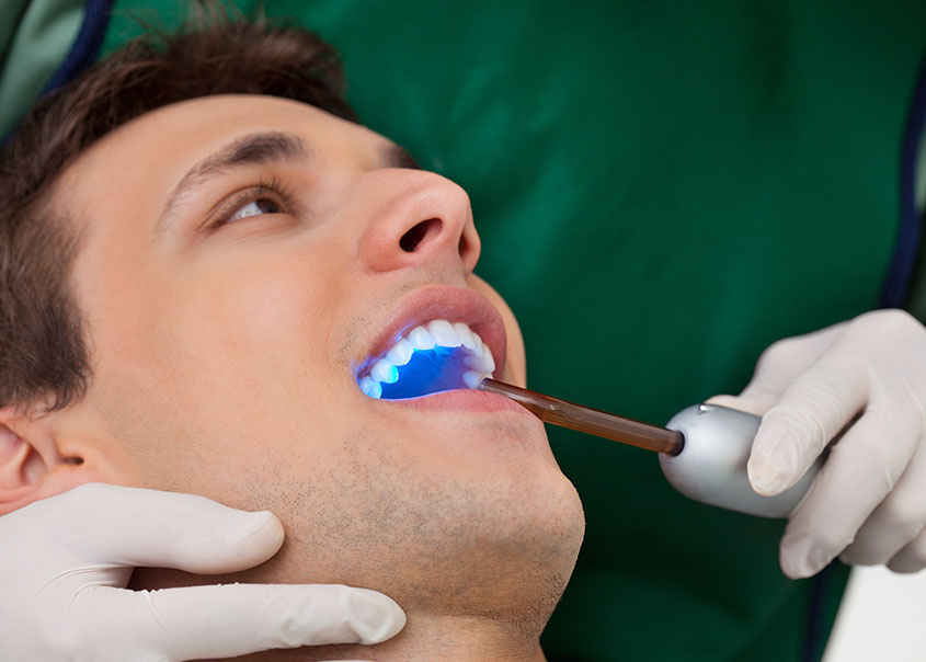 Dental Sealants | Mirage Dental | General and Family Dentist | SE Calgary