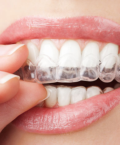 Invisalign® | Mirage Dental | General and Family Dentist | SE Calgary