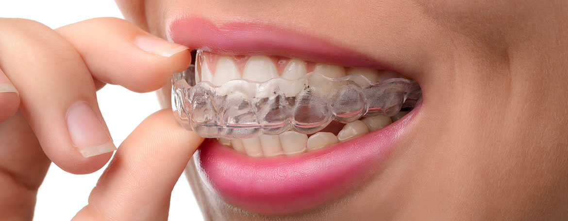 Invisalign® | Mirage Dental | General and Family Dentist | SE Calgary