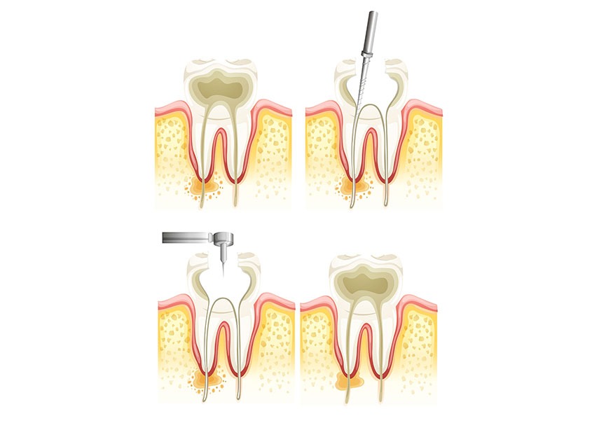 Root Canal Therapy | Mirage Dental | General and Family Dentist | SE Calgary