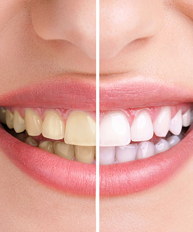 Teeth Whitening | Mirage Dental | General and Family Dentist | SE Calgary