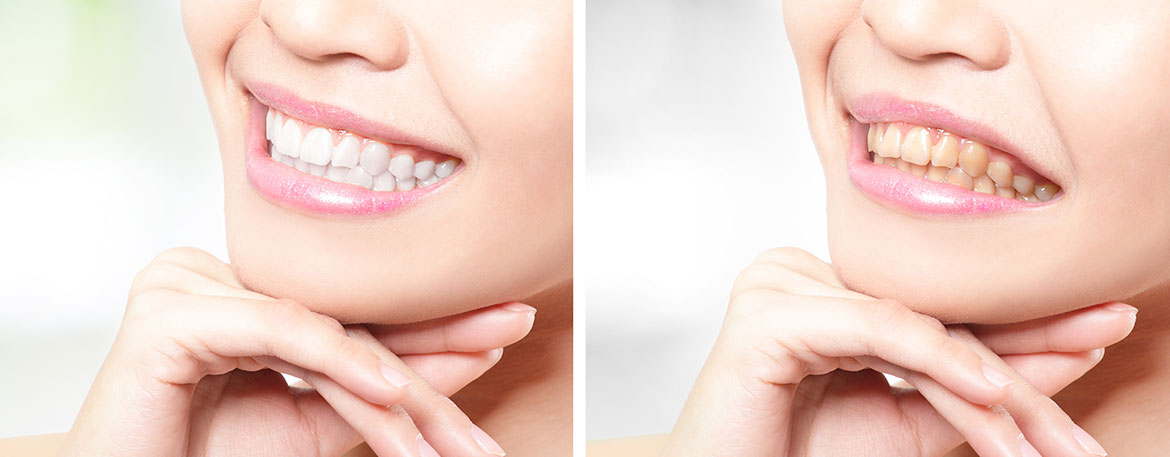 Teeth Whitening Treatment Calgary | Mirage Dental | General and Family Dentist | SE Calgary