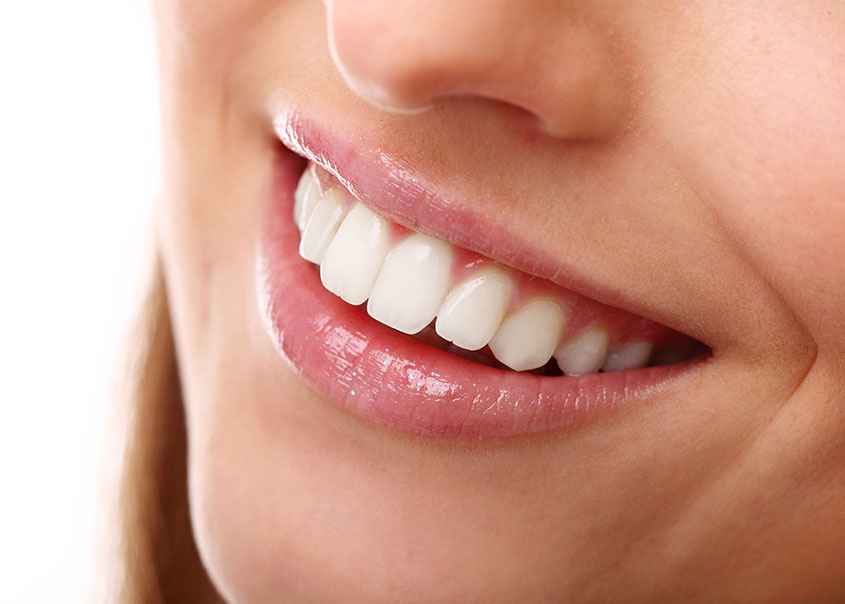 Teeth Whitening | Mirage Dental | General and Family Dentist | SE Calgary