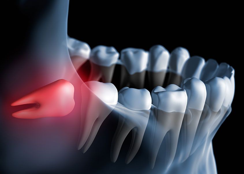 Wisdom Teeth Extractions | Mirage Dental | General and Family Dentist | SE Calgary