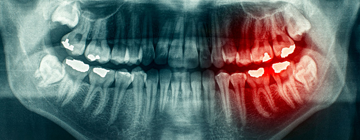Wisdom Teeth Extractions | Mirage Dental | General and Family Dentist | SE Calgary
