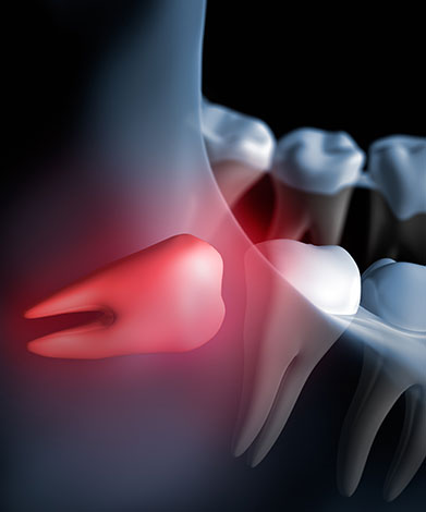Calgary Wisdom Teeth Extractions | Mirage Dental | General and Family Dentist | SE Calgary