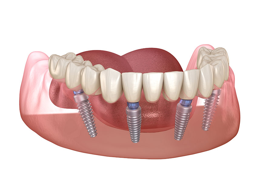 All-on-X Dental Implants | Mirage Dental | General and Family Dentist | SE Calgary