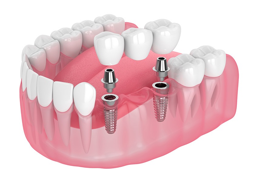 Dental Implant Supported Bridge | Mirage Dental | General and Family Dentist | SE Calgary