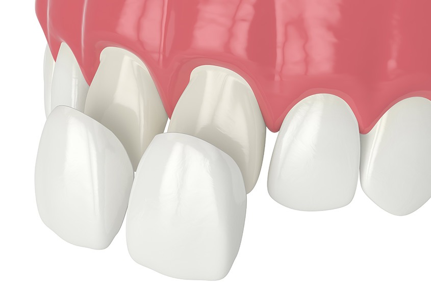 Porcelain Veneers | Mirage Dental | General and Family Dentist | SE Calgary