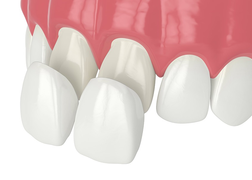 Calgary Porcelain Veneers | Mirage Dental | General and Family Dentist | SE Calgary